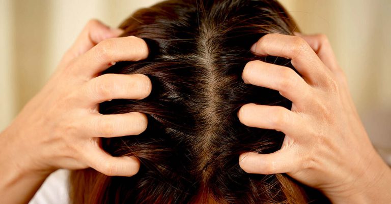 Find Out the 3 Types of Scalp Problems and the Treatments to Avoid Symptoms from Worsening