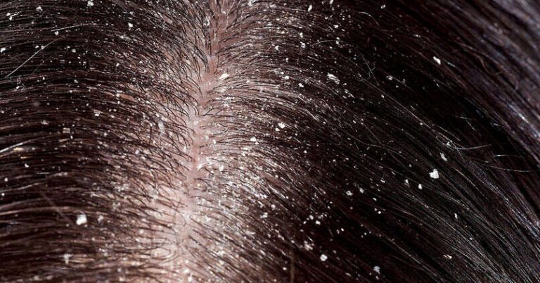 5 Easy Ways to Treat Flaky Scalp